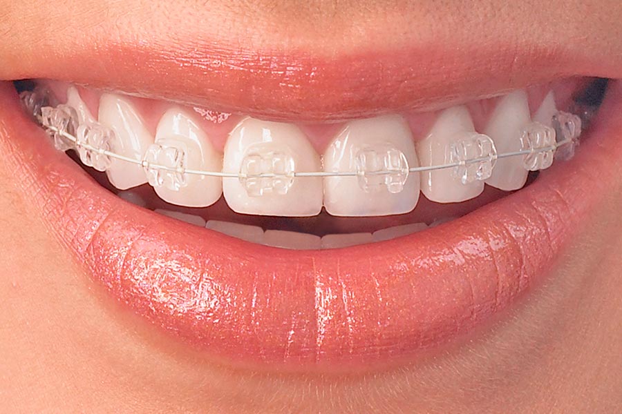 Ceramic braces
