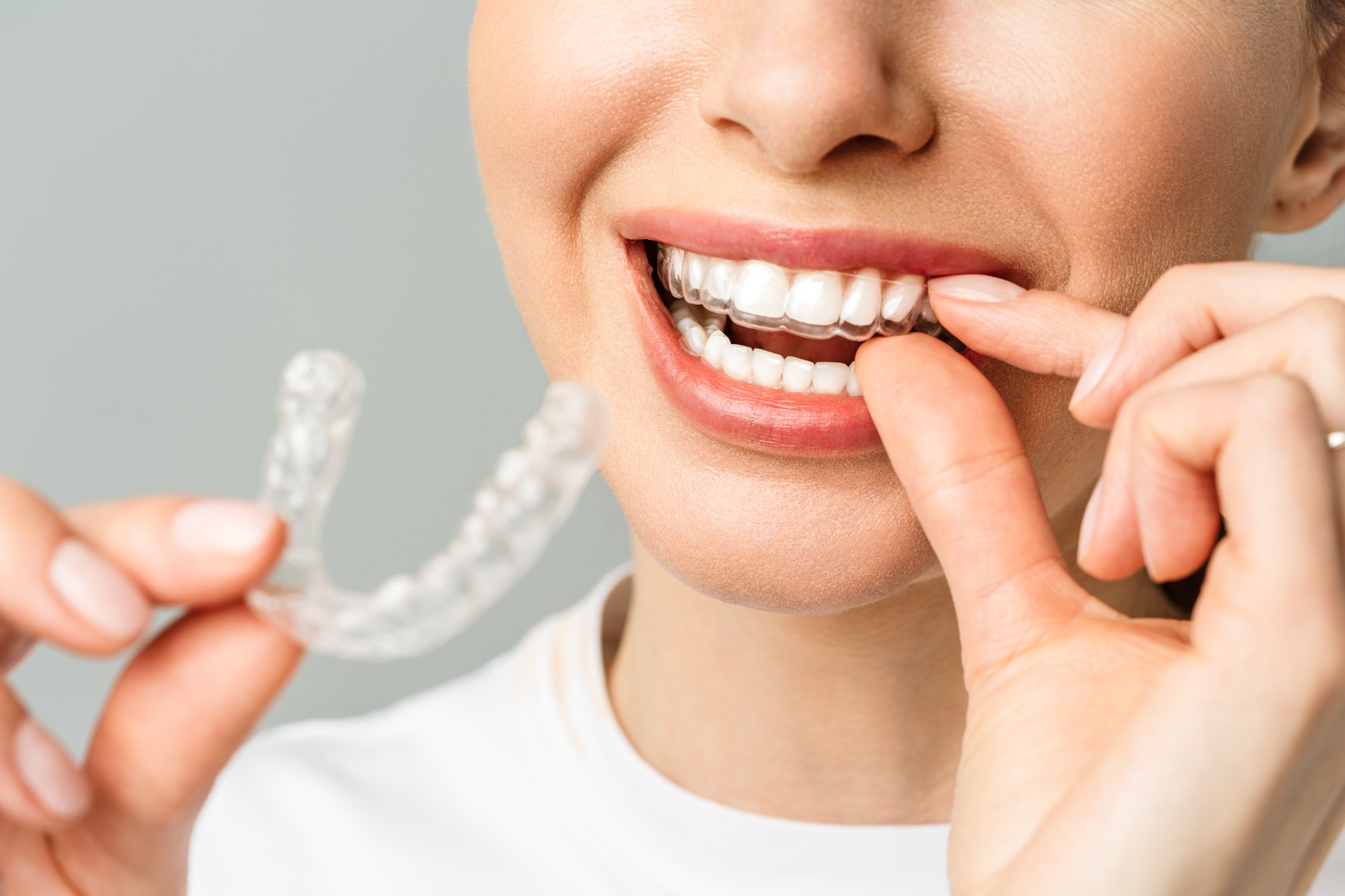 Clear aligners